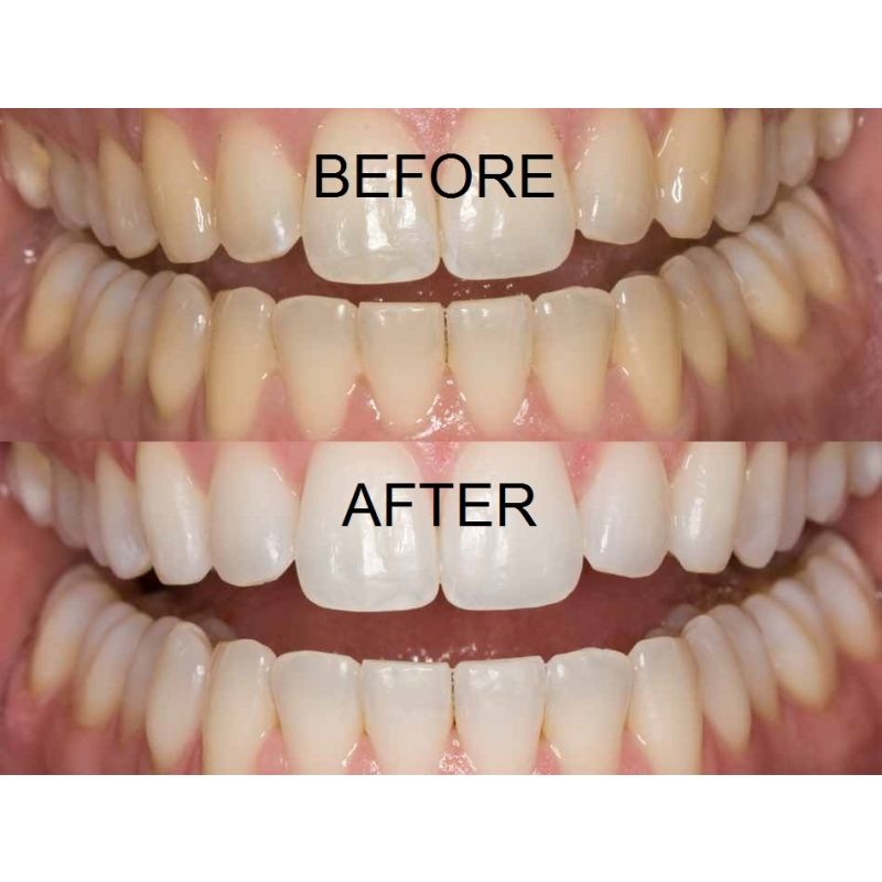 Opalescence Pf 10 Melon Teeth Whitening Gel Syringes 4 X 1 2ml Syringes And Instructions Buy Teeth Whitening 165021