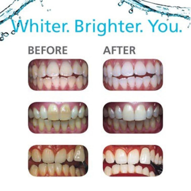 Polanight Dental Grade Teeth Whitening Kit | Buy Teeth ...