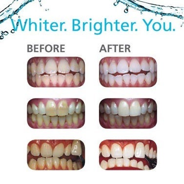 polanight teeth whitening before and after