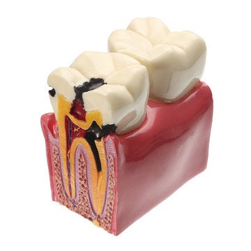 Caries Teeth Comparation Model Dental Study Education Demonstration