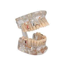 Pro Dental Study Education Teach Implant Teeth Model Restoration Bridge Medical Model