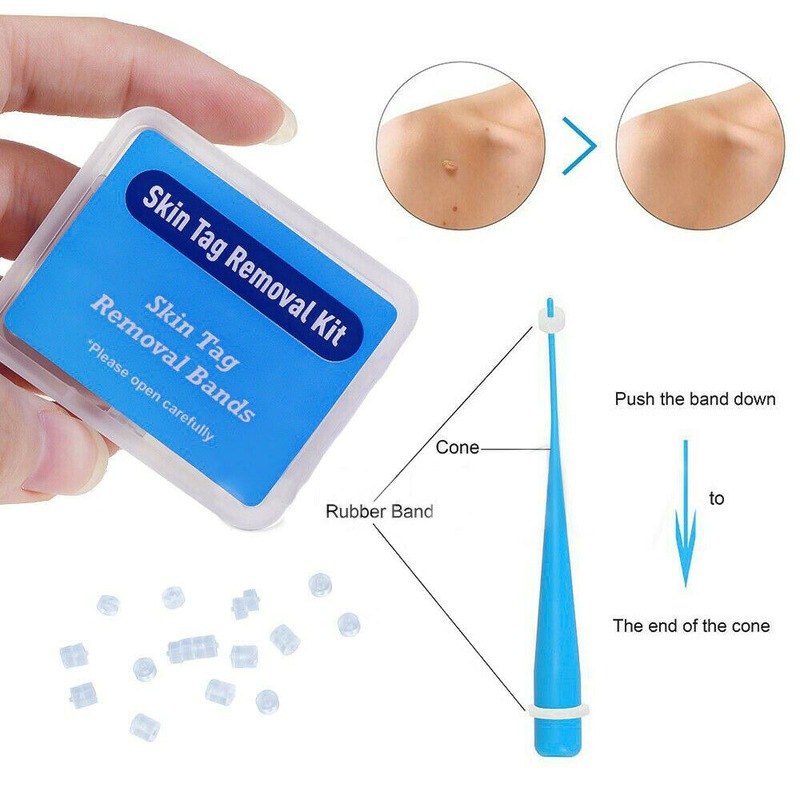 Buy Skin Tag Remover Kit for Fast & Effective Skin Tag Removal MyDeal